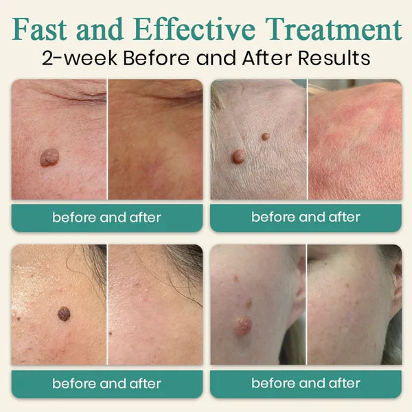 Xorita™ Mole and Wart Instant Removal Laser Pen