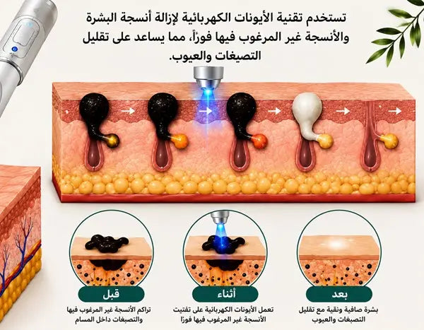 Xorita™ Mole and Wart Instant Removal Laser Pen